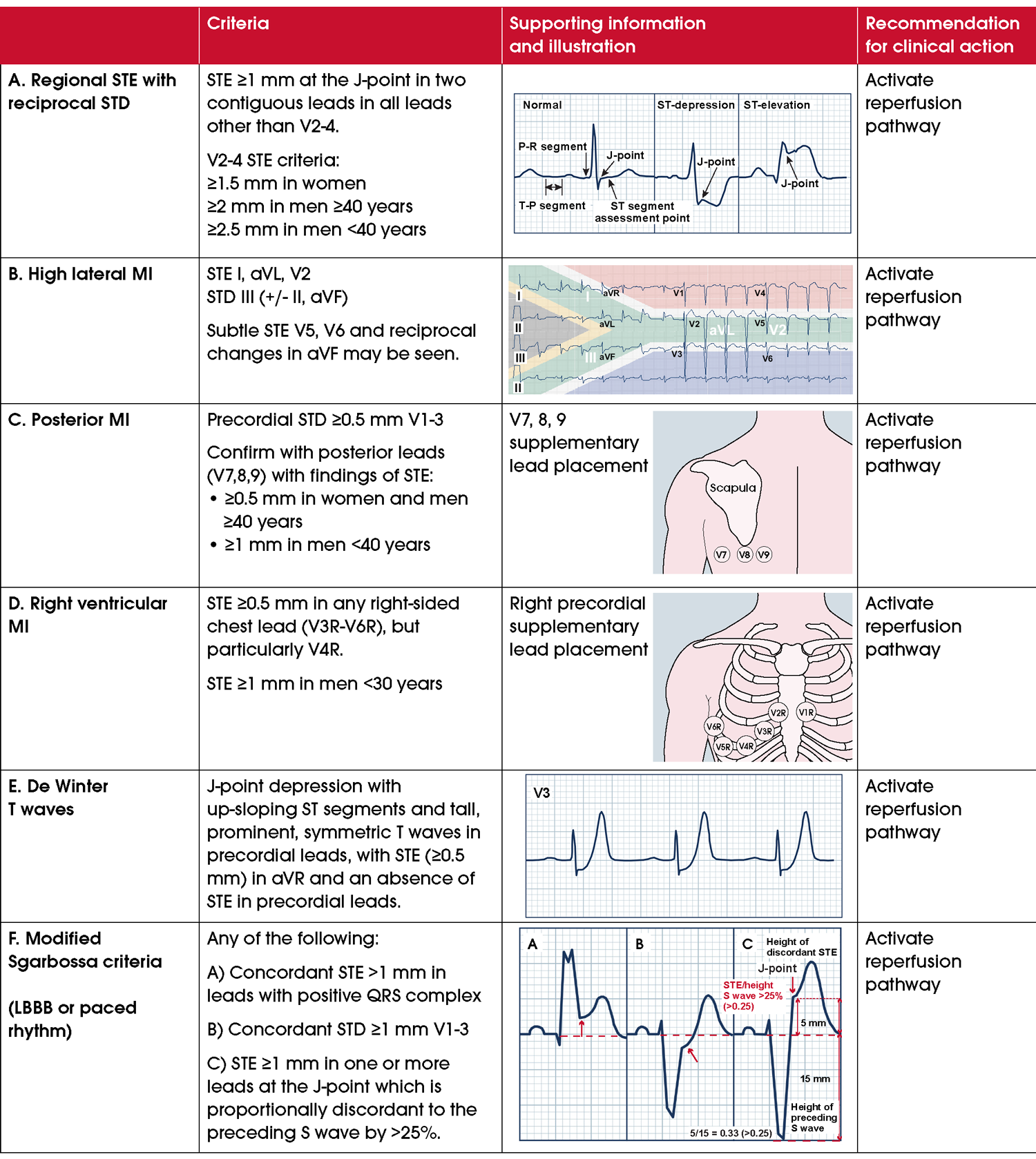 Figure 4 ECG findings consistent with acute coronary occlusion myocardial infarction (ACOMI)